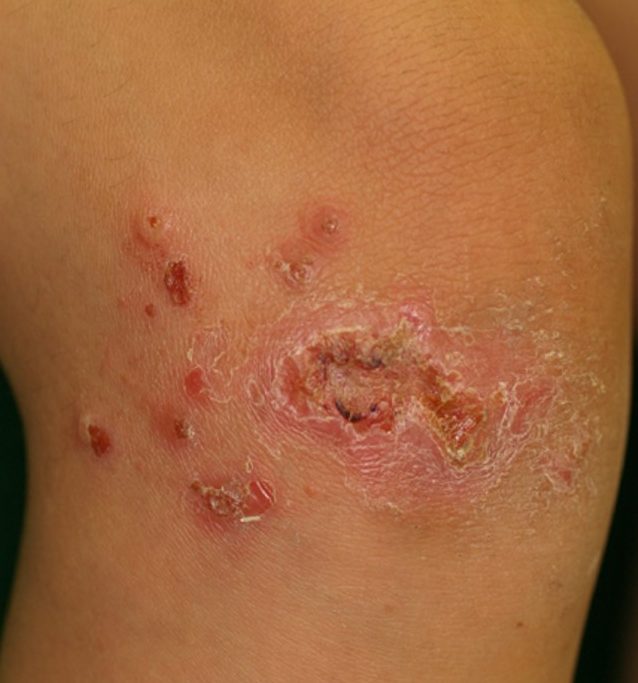 伝染性膿痂疹臨床写真